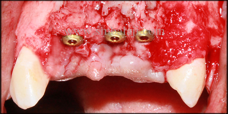 Replacement of Missing Teeth with Dental Implants for a Dazzling Smile 3 Dental implants fixed at the relative site
