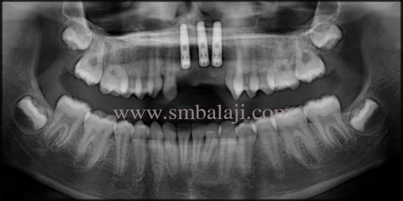 Replacement of Missing Teeth with Dental Implants for a Dazzling Smile 4 Post-operative OPG taken after 3months shows well osseointegrated dental implants