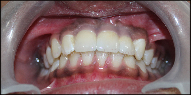 Replacement of Missing Teeth with Dental Implants for a Dazzling Smile 5 Natural looking fixed ceramic prosthesis with perfect colour match