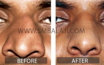 Crooked nose before after surgery