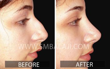 Rhinoplasty Surgery cost in India