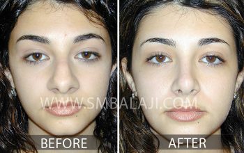 Rhinoplasty Surgery in India