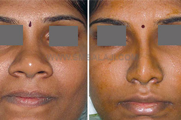 Nose-reduction-surgery-of-a-very-broad-nose-chennai-india-before-after-picture Rhinoplasty Before After