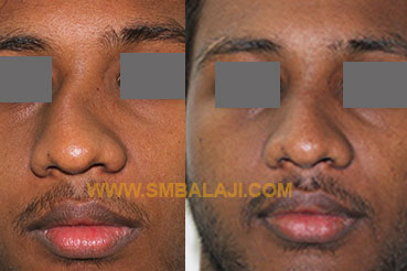 Surgical-correction-of-a-crooked-nose-before-after Rhinoplasty Before After