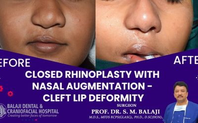 OPEN VS CLOSED RHINOPLASTY WHICH TECHNIQUE IS BEST?