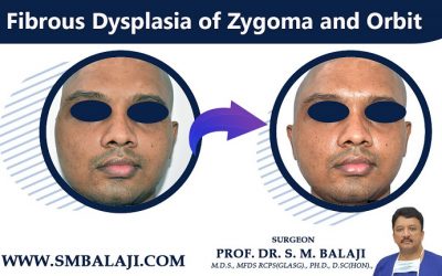 Fibrous Dysplasia of Zygoma and Orbit