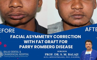 Facial Asymmetry Correction with Fat Graft for Parry Romberg Disease