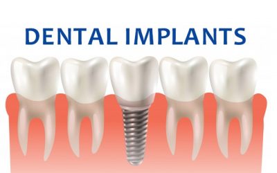 Best Dental Implant Clinic in India