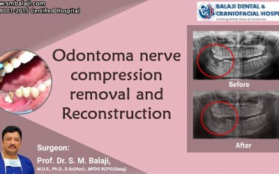Odontoma Nerve Compression Removal and Reconstruction
