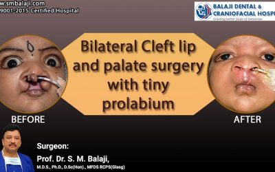 Bilateral Cleft Lip and Palate Surgery with Tiny Prolabium