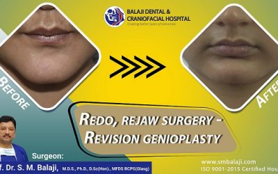 Redo, Rejaw surgery – Revision Genioplasty