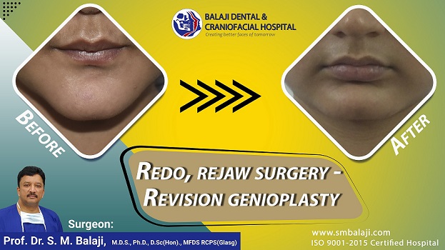 Redo, Rejaw surgery – Revision Genioplasty