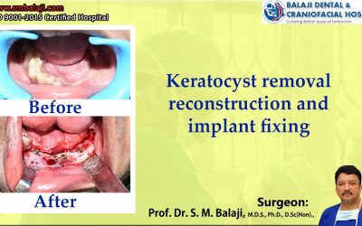 Keratocyst Removal, Reconstruction and Implant Fixing