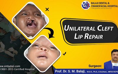 Unilateral Cleft lip repair