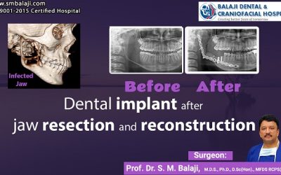 Dental Implant after Jaw Resection and Reconstruction