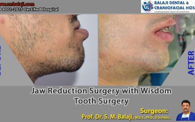 Jaw Reduction Surgery with Wisdom Tooth Surgery