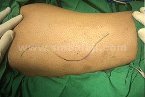 Tensor fascia lata graft obtained from the vastus lateralis muscle