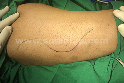 Tensor fascia lata graft obtained from the vastus lateralis muscle
