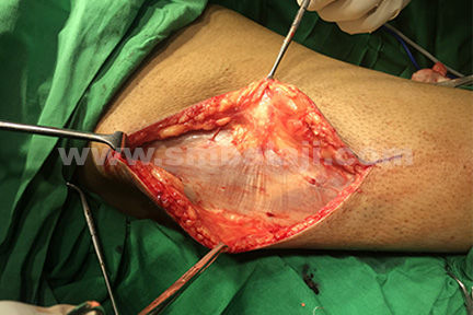Tensor fascia lata graft obtained from the vastus lateralis muscle