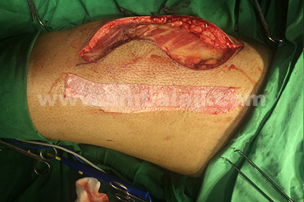 Tensor fascia lata graft obtained from the vastus lateralis muscle