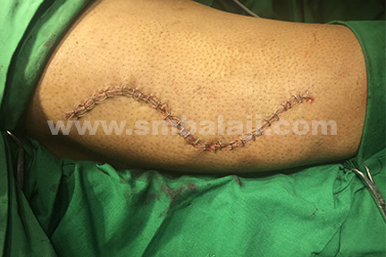 Tensor fascia lata graft obtained from the vastus lateralis muscle