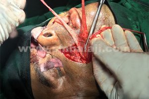 dynamic reanimation surgery performed by Dr S M Balaji using the temporalis muscle and fascia lata graft