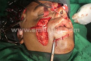 dynamic reanimation surgery performed by Dr S M Balaji using the temporalis muscle and fascia lata graft