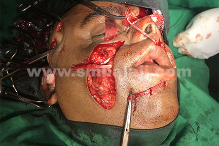 dynamic reanimation surgery performed by Dr S M Balaji using the temporalis muscle and fascia lata graft