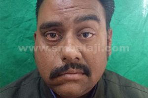 forehead on the palsy affected right side of face