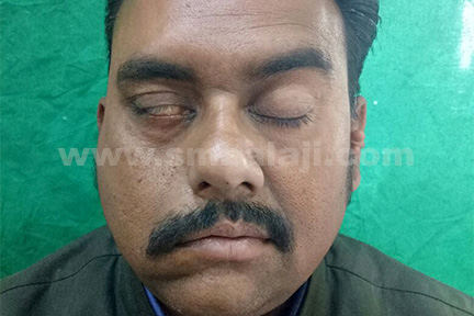 forehead on the palsy affected right side of face