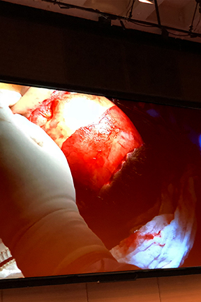 Facial feminization live surgical demonstration in progress at the First Live Surgery Symposium of the WPATH, held in New York City, USA