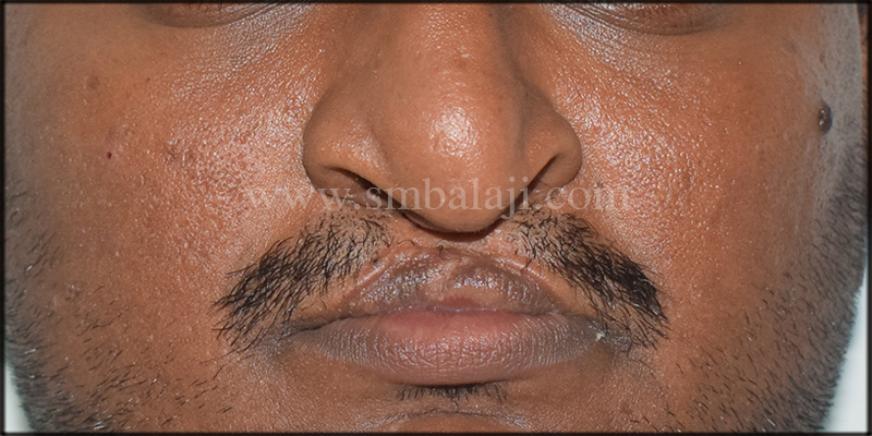Pre-operative facial view showing defective lip and nose due to bilateral cleft lip and palate