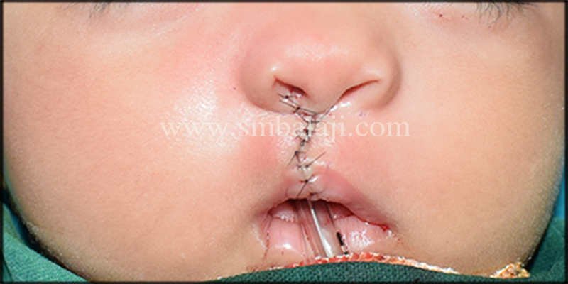 Primary cleft lip repair done using Modified Millard’s technique