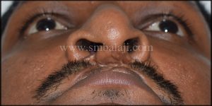 Worm's eye view showing depressed dorsum of nose and illdefined columella