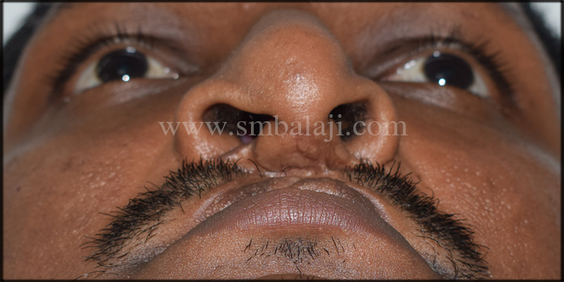 Worm's eye view showing depressed dorsum of nose and illdefined columella