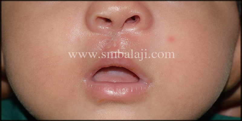 Immediately after suture removal showing improved appearance