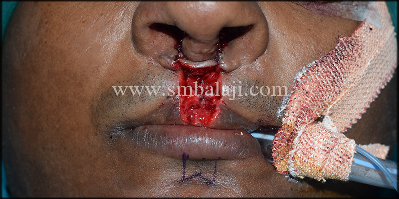 Intra-operative view showing raised columella of nose