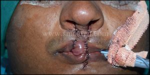 Immediately after suturing using Abbe flap technique