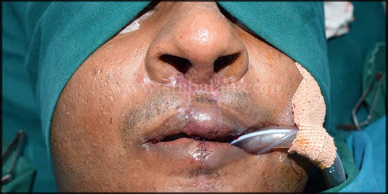 Immediately after suture removal showing enhanced appearence of the nose and upper lip