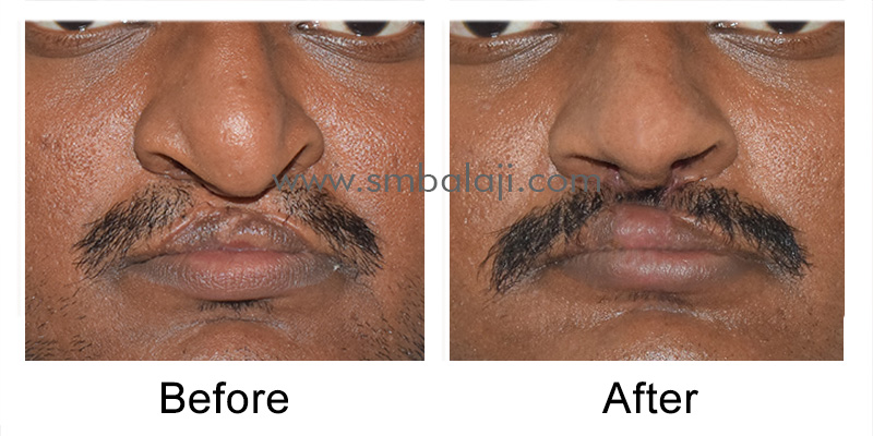 Before-After Straight view