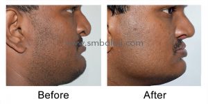 Before-After Side view