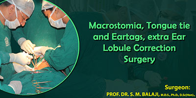 Macrostomia, Tongue tie and Ear tags, extra Ear Lobule Correction Surgery