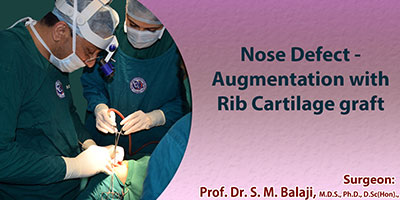 Nose Defect – Augmentation with Rib Cartilage graft