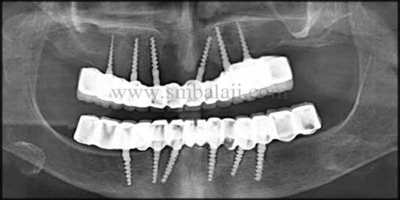 Zygoma implants for Atrophic upper jaw 1 Pre-operative x-ray taken shows diffuse radiolucency around the implants in the upper and lower arch indicating severe bone loss