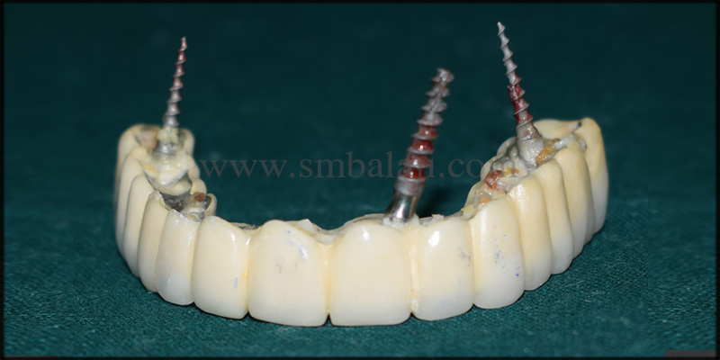 Zygoma implants for Atrophic upper jaw 2 Infected prosthesis removed under local anesthesia
