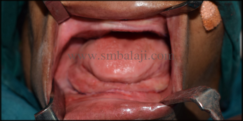 Zygoma implants for Atrophic upper jaw 3 Patient after healing of the gum tissues