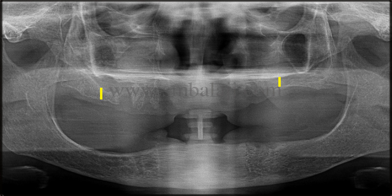 Zygoma implants for Atrophic upper jaw 4 OPG taken shows insufficient bone height in the upper posterior region