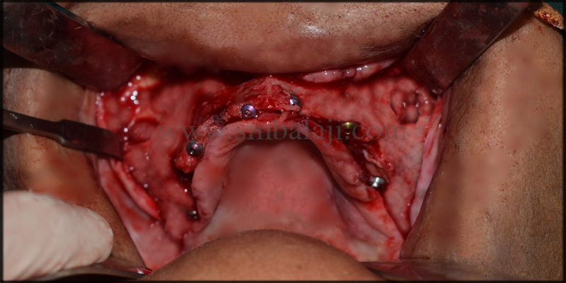 Zygoma implants for Atrophic upper jaw 5 Patient after healing of the gum tissues