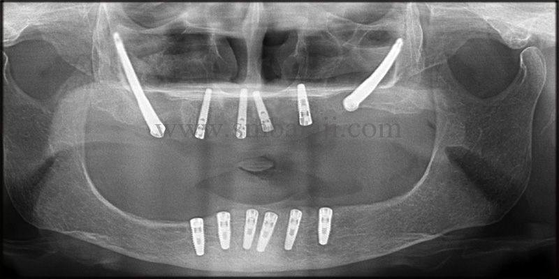 Zygoma implants for Atrophic upper jaw 6 Post-operative OPG shows well osseointegrated dental implants with the jaw bone