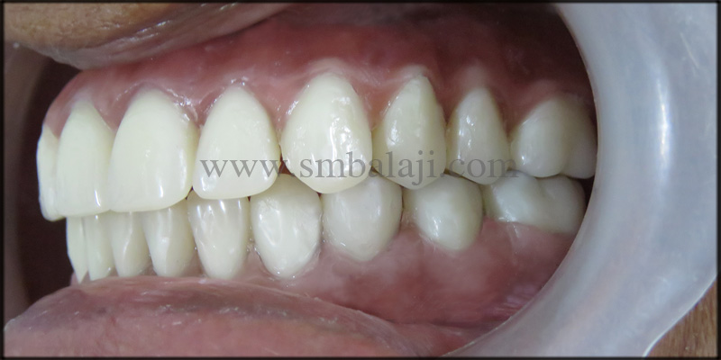 Zygoma implants for Atrophic upper jaw 7 Natural looking fixed prosthesis with proper bite position